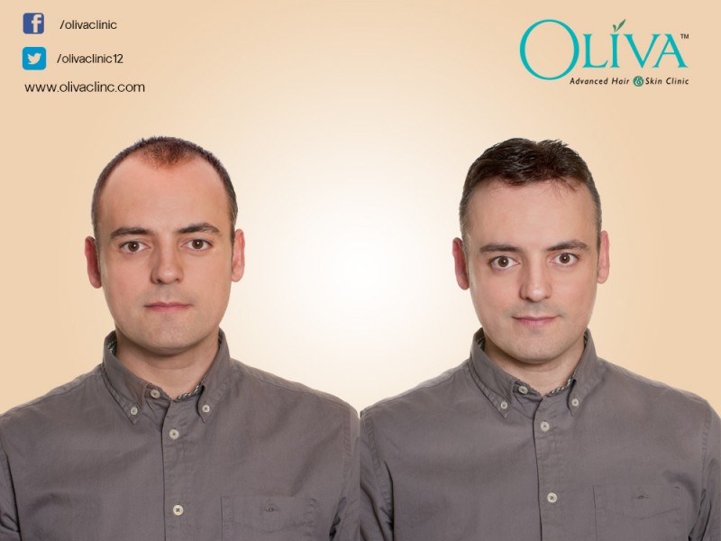 PRP Hair Loss Treatment In Hyderabad - Oliva Clinic Hyderabad-India -  localFROG